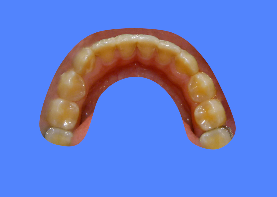 After image showing patient with aligned teeth